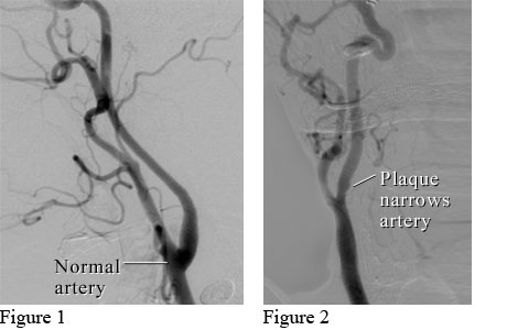 HVI Carotid Artery